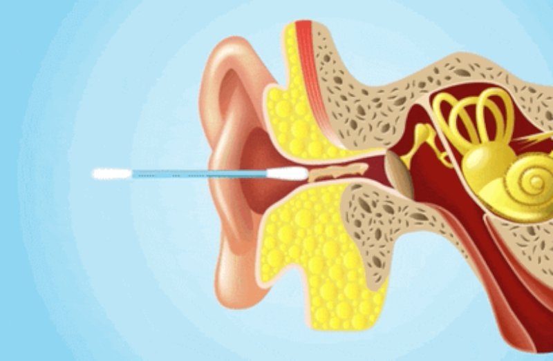 Kit Removedor de Cera de Ouvido com 6 Peças Inox
